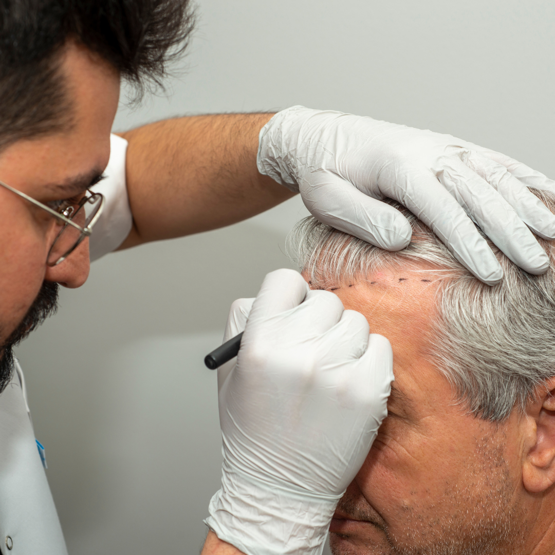 haartransplantatie Zwolle